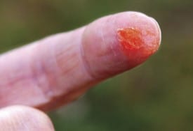 FireGel_finger Fire Gel application